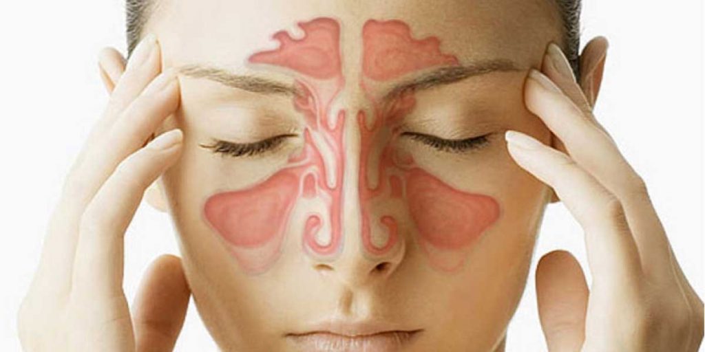 Sinusitis Causas Sntomas Y Tratamiento