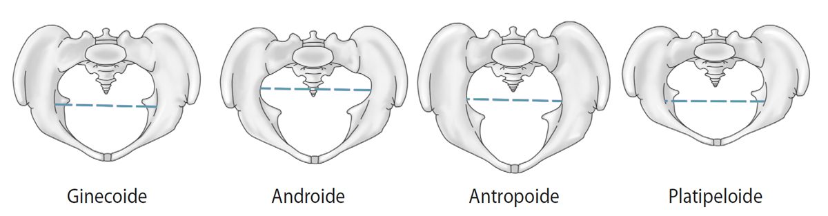 Los 4 Tipos De Pelvis Con celas EOM Internacional